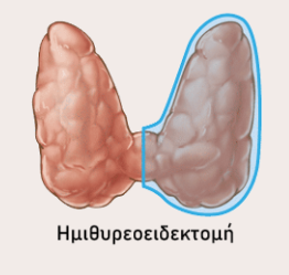 ημιθυρεοειδεκτομή
