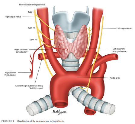 μη παλίνδρομο κάτω λαρυγγικό νεύρο, θυρεοειδεκτομη Ιωαννινα, ΩΡΛ Ιωάννινα, νευροδιεγερση πνευμονογαστρικου, νευροπαρακολούθηση