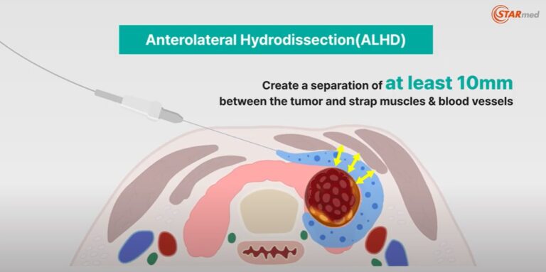 προσθιοπλάγιος υδροδιαχωρισμός (Anterolateral hydrodissection, ALHD) που