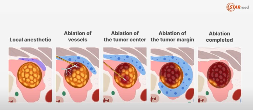 Θερμοκαυτηρίαση με Ραδιοσυχνότητες (Radiofrequency Ablation)