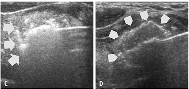 υπερηχογενές τόξο (hyperechoic arc) στον Υπερηχο