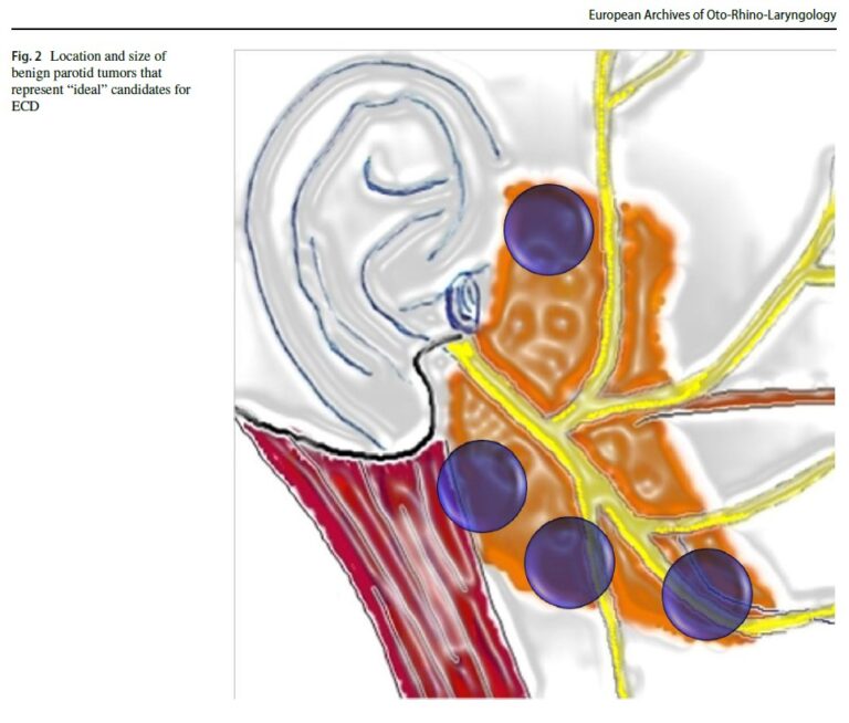 Ιδανικες Ενδείξεις Εξωκαψικής Παρωτιδεκτομής