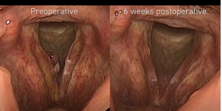 Laser microsurgery of laryngeal polyp combined with leukoplakia
