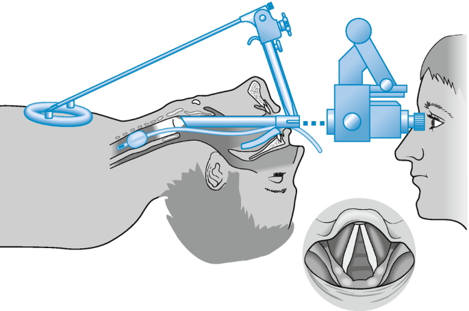 Μικρολαρυγγοσκοπηση