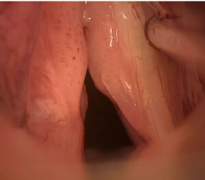 υποτροπή θηλωματος Λαρυγγα