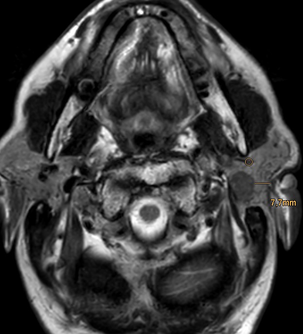 MRI μορφωματος εν τω βαθει λοβού της παρωτίδας