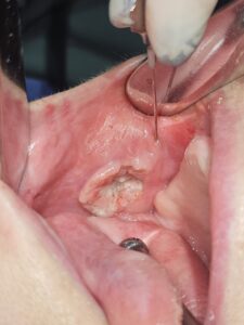 Όγκος παρειάς στη στοματική κοιλότητα με καθετηριασμό του πόρου της παρωτίδας κατά τη χειρουργική αντιμετώπιση