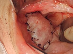 Μετεγχειρητική εικόνα παρειάς μετά από αφαίρεση καρκινικού όγκου και συρραφή