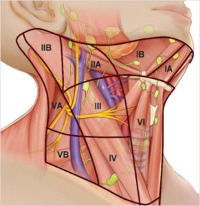 Ιατρικό διάγραμμα των επιπέδων των λεμφαδένων στον τράχηλο του ανθρώπου, σημειωμένα από I έως VI.