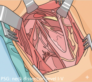 Σχηματική απεικόνιση ανατομίας τραχήλου και λεμφαδενικού καθαρισμού με χειρουργικά εργαλεία.