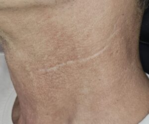 Πλαστική Τομή Πλάγιου Λεμφαδενικού Καθαρισμού Τραχήλου