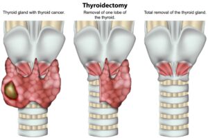 Τhyroidectomy thyroid gland 3d medical vector illustration on white background