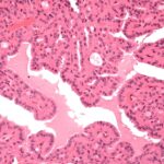 Hürthle cells - μικροσκόπιο